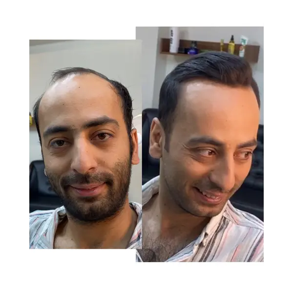 نمونه ترمیم موقت مو داماد