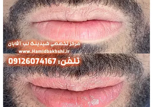 رفع تیرگی لب آقایان