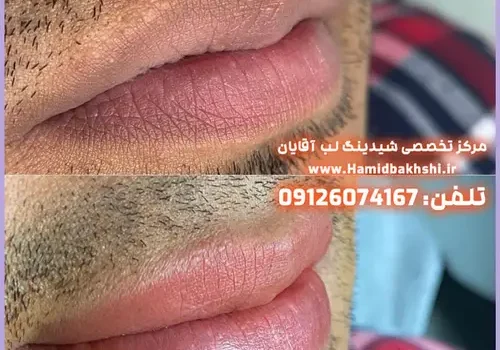 هزینه شیدینگ لب آقایان