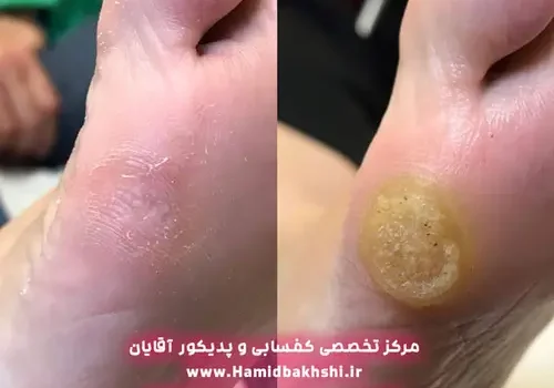 درمان پینه کف پا در آقایان