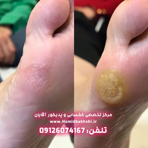 درمان پینه کف پا در آقایان