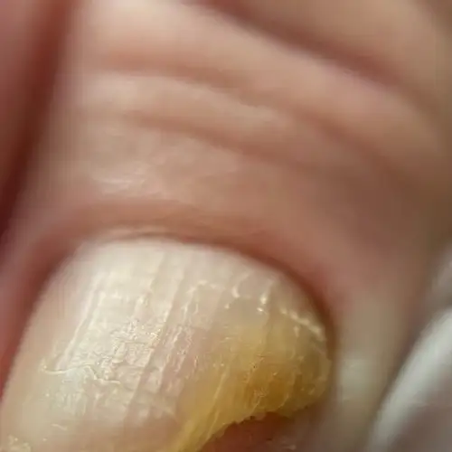 مشکلات ناخن آقایان