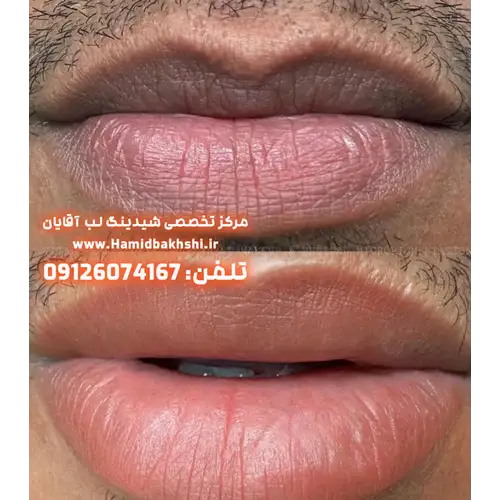 احیای رنگ طبیعی لب مردانه