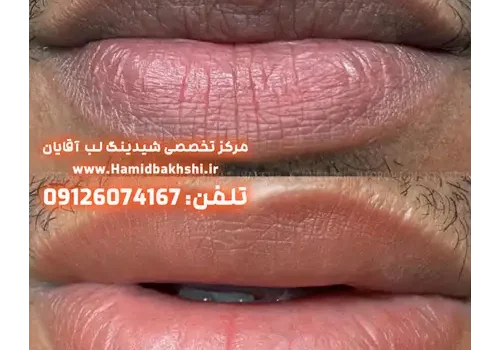 از بین بردن سیاهی لب آقایان