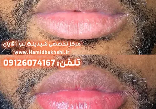 روشن کردن لب‌های تیره