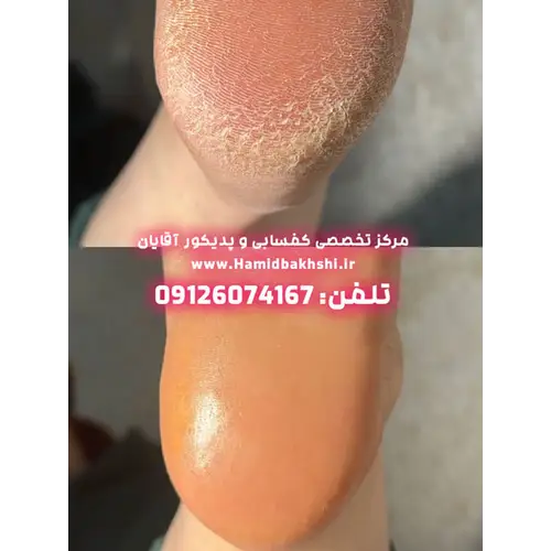 رفع ترک پا در آقایان