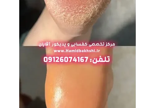 درمان پینه های قدیمی پا در آقایان