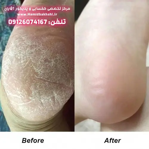 نرم کردن کف پای مردانه