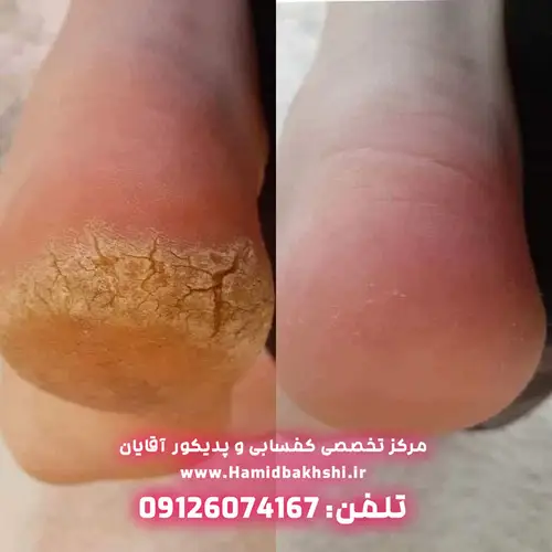 نرم کردن کف پای مردانه