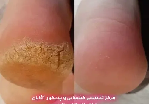 درمان ترک پا و پینه در آقایان