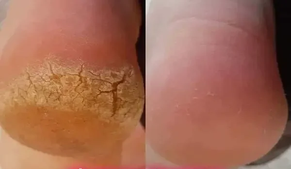 پدیکور خشک مردانه در تهران