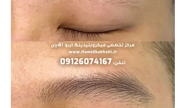 هزینه فیبروز ابرو آقایان چقدره؟