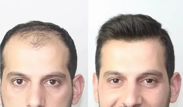 پروتز تکه ای برای شقیقه