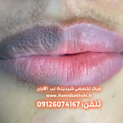 از بین بردن سیاهی لب آقایان